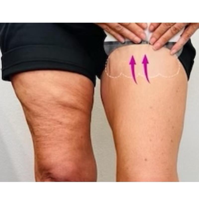 Skinnies Instant Thigh Lift (5 Pair)    Patented Body Shaping Tape- Instantly Lifts Thigh Skin & Smooths all signs of cellulite and saggy, crepe skin away for  appearance of tight, firm legs.  Shapewear Body Tape Body Shape Tape Thigh Lift Tape Womenswear